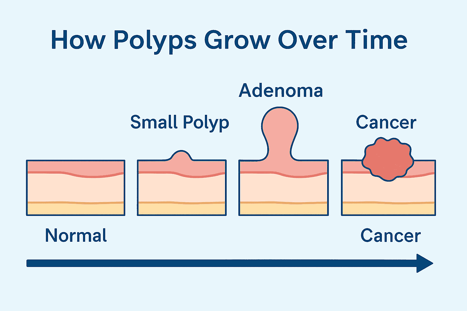 polyp progression to cancer