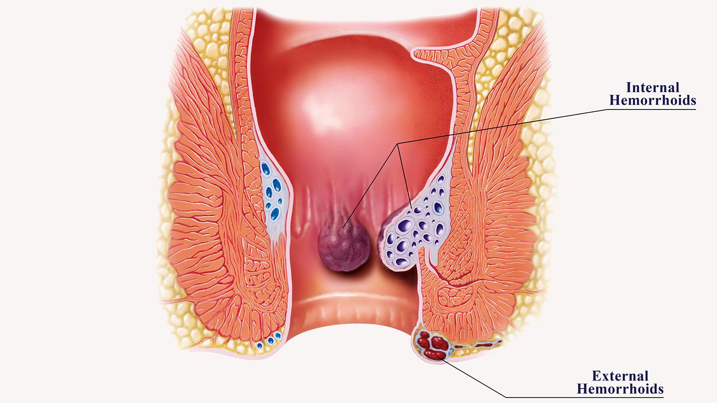 hemorrhoids-best-worst-foods-for-hemorrhoids-what-to-eat-what-to